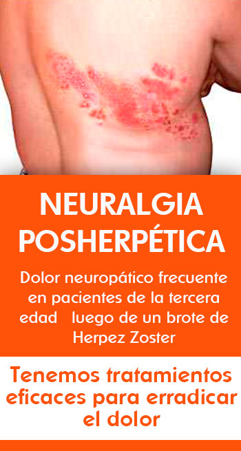 Neuralgia Posherpética